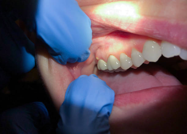 Best Emergency Dentist for Knocked-Out Tooth in Simpson, PA